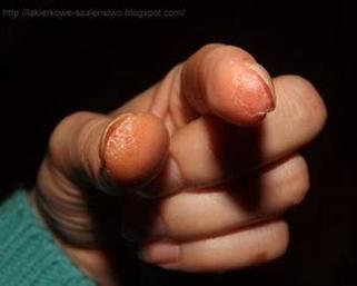 Bezpieczne alternatywy dla alergików