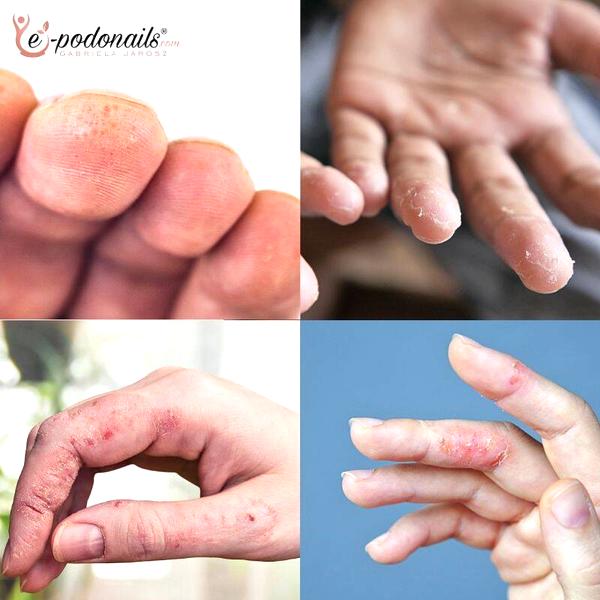 Uczuleniu na hybrydę