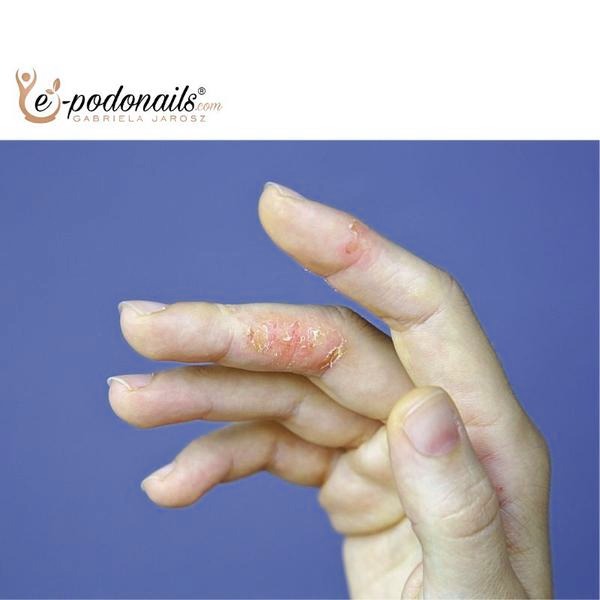 Jak skutecznie zastąpić hybrydę w przypadku uczulenia?